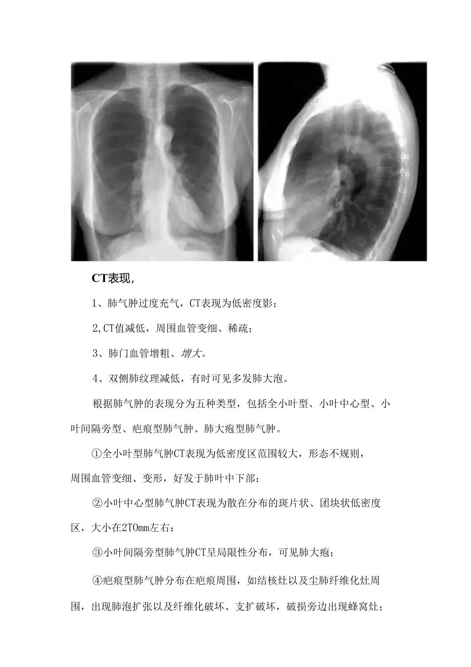 肺气肿影像学表现与鉴别诊断.docx_第3页