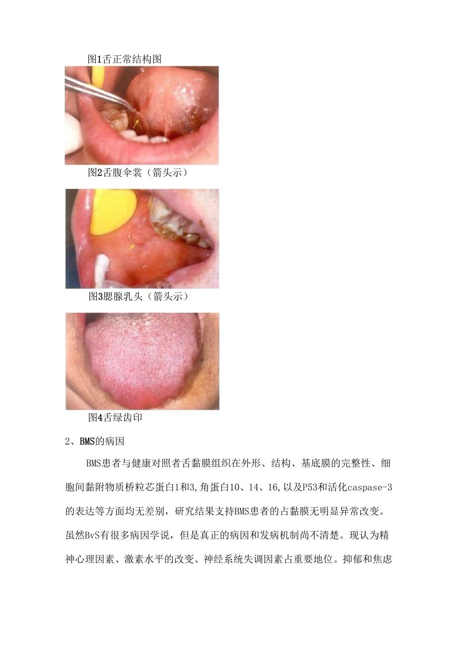 灼口综合征的诊断与治疗.docx_第2页