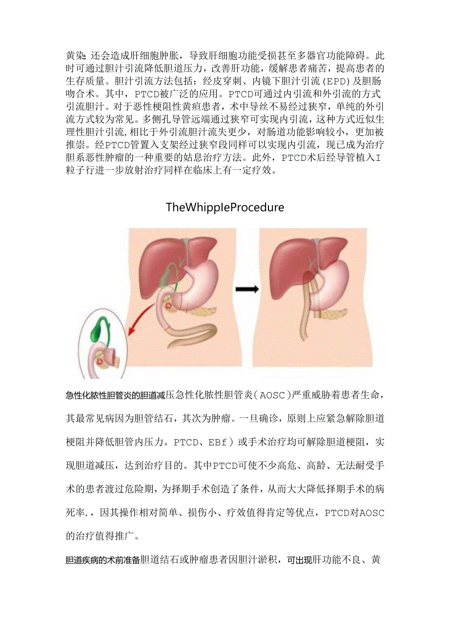 经皮肝穿刺胆管引流术（PTCD）.docx_第2页