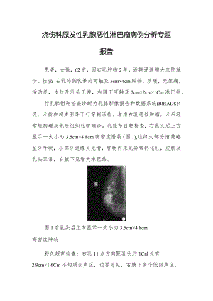 烧伤科原发性乳腺恶性淋巴瘤病例分析专题报告.docx