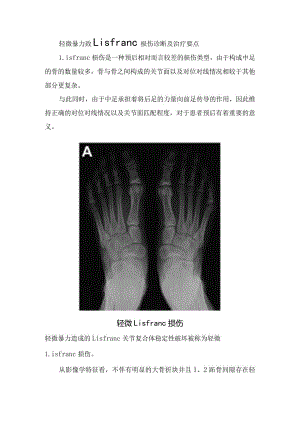 轻微暴力致Lisfranc损伤诊断及治疗要点.docx