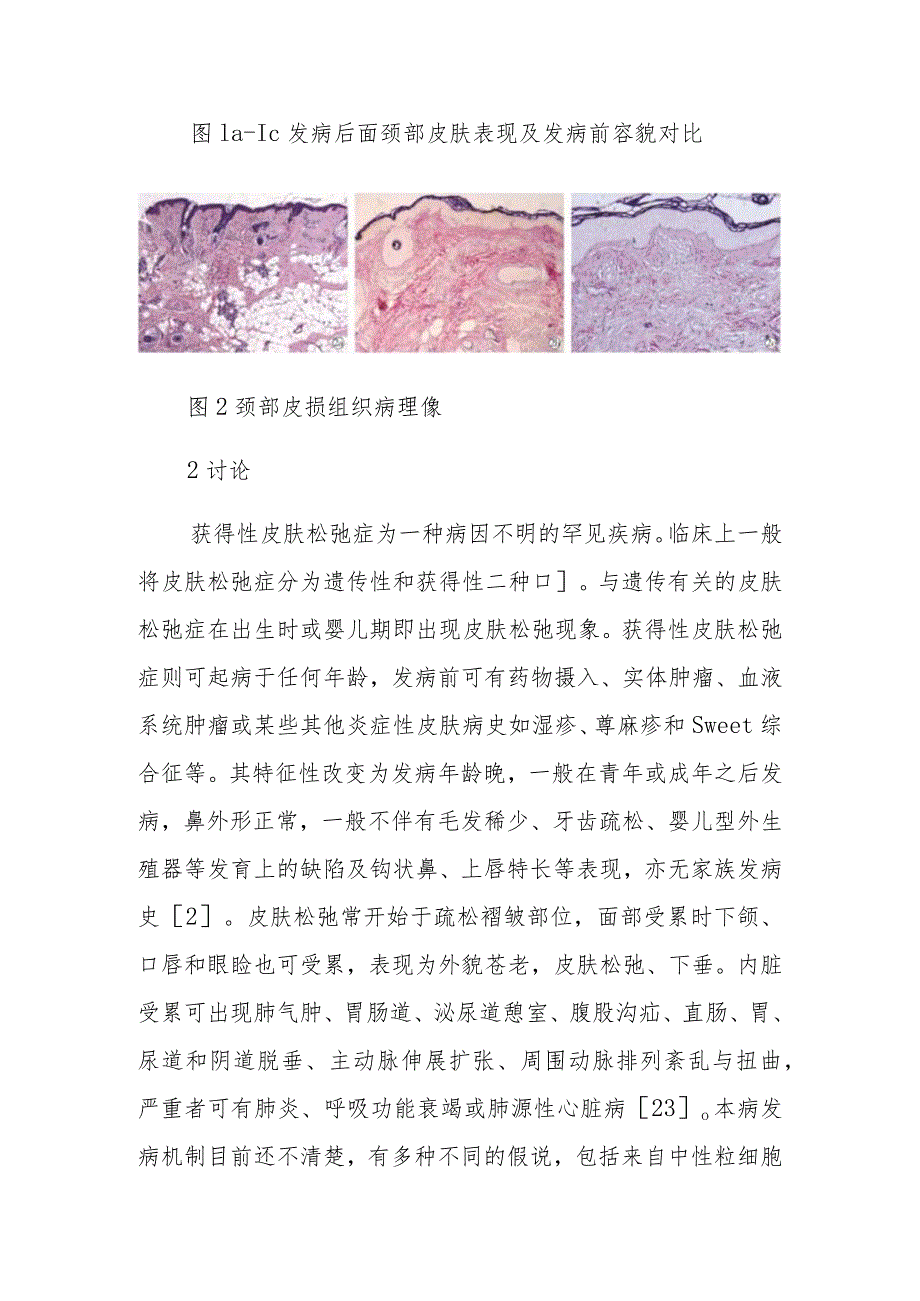 皮肤科获得性皮肤松弛症病例分析专题报告.docx_第2页