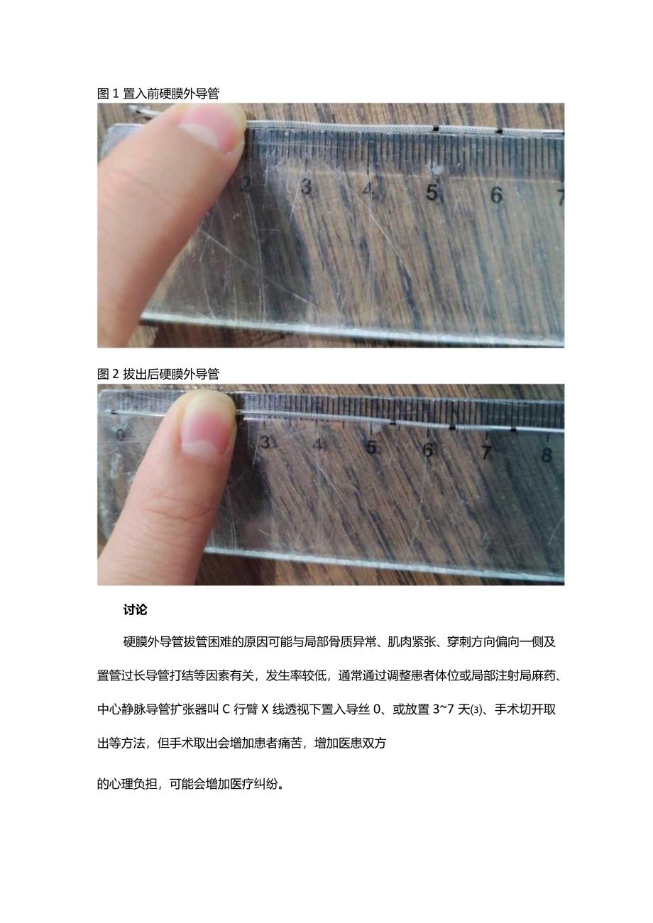 一例分娩镇痛硬膜外导管拔管困难的处理.docx_第2页
