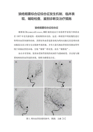 狼疮烟雾综合征综合征发生机制、临床表现、辅助检查、鉴别诊断及治疗措施.docx