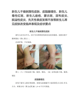 新生儿干燥剥落性皮肤、皮脂腺增生、新生儿毒性红斑、 新生儿痤疮、蒙古斑、尿布皮炎、脱溢性皮炎、先天性表皮发育不良等新生儿常见皮肤.docx
