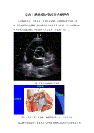 临床主动脉瓣狭窄超声诊断要点.docx