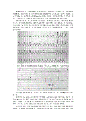 Fontaine导联显露室速背后原因（识图寻踪）.docx