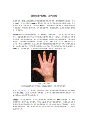 烧伤后如何处理？如何治疗.docx