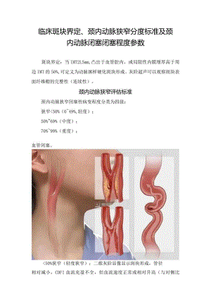 临床斑块界定、颈内动脉狭窄分度标准及颈内动脉闭塞闭塞程度参数.docx
