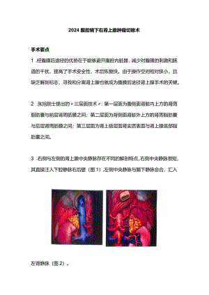 2024腹腔镜下右肾上腺肿瘤切除术.docx