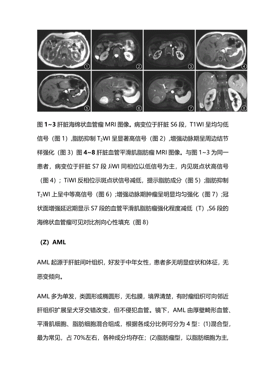 2024肝脏常见良性肿瘤的MRI表现.docx_第3页