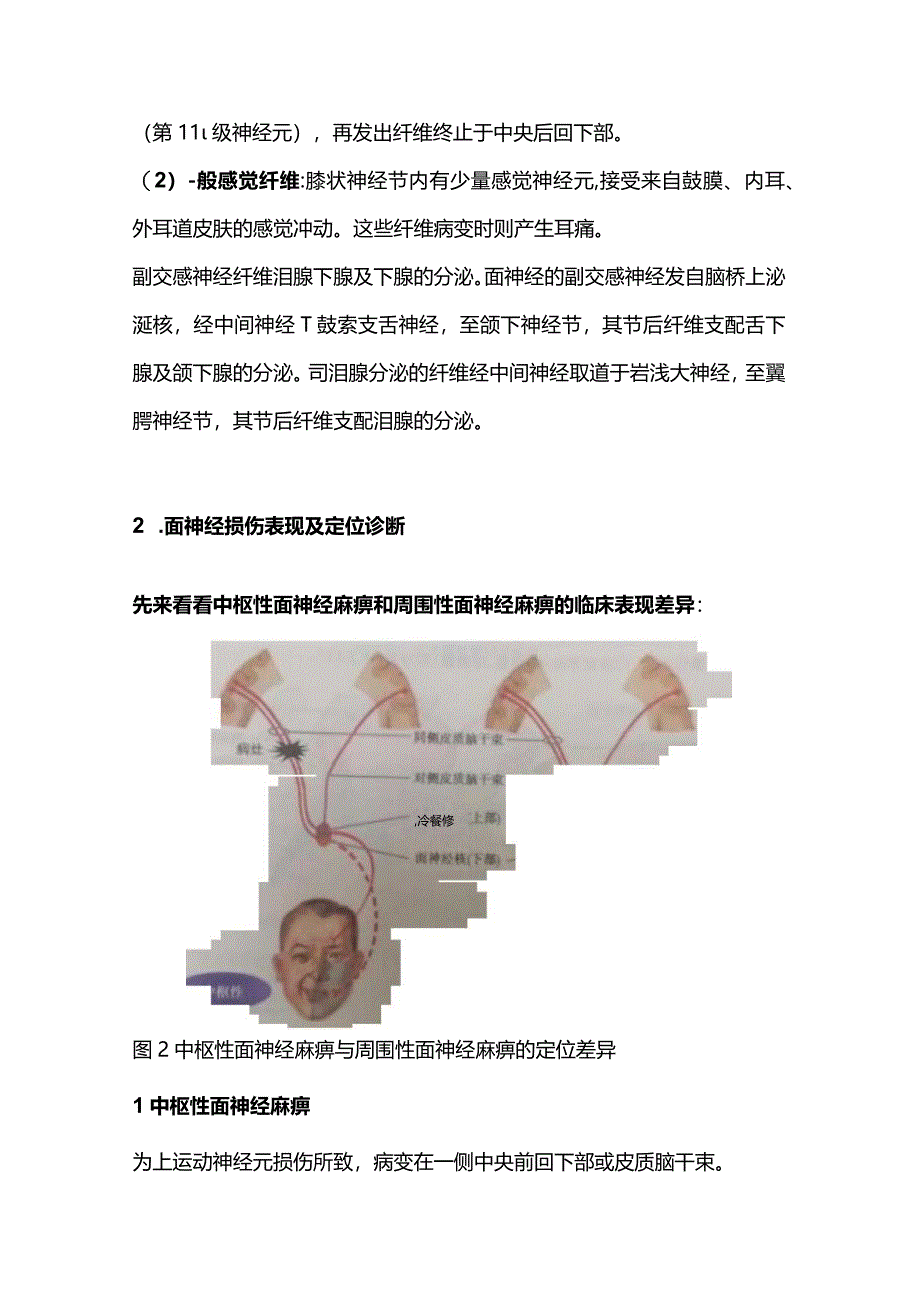 2024中枢性面瘫与周围性面瘫的鉴别.docx_第3页