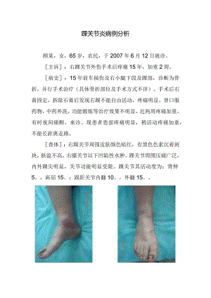 踝关节炎病例分析.docx