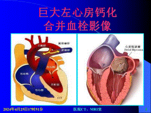 巨大左心房钙化合并血栓影像.ppt