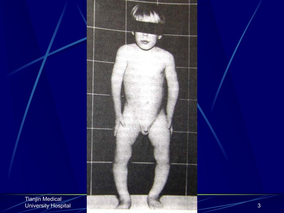 [资料]佝偻病和软骨病.ppt_第3页