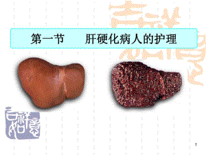 肝硬化病人的护理.ppt