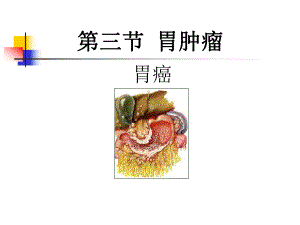 胃癌.ppt.ppt