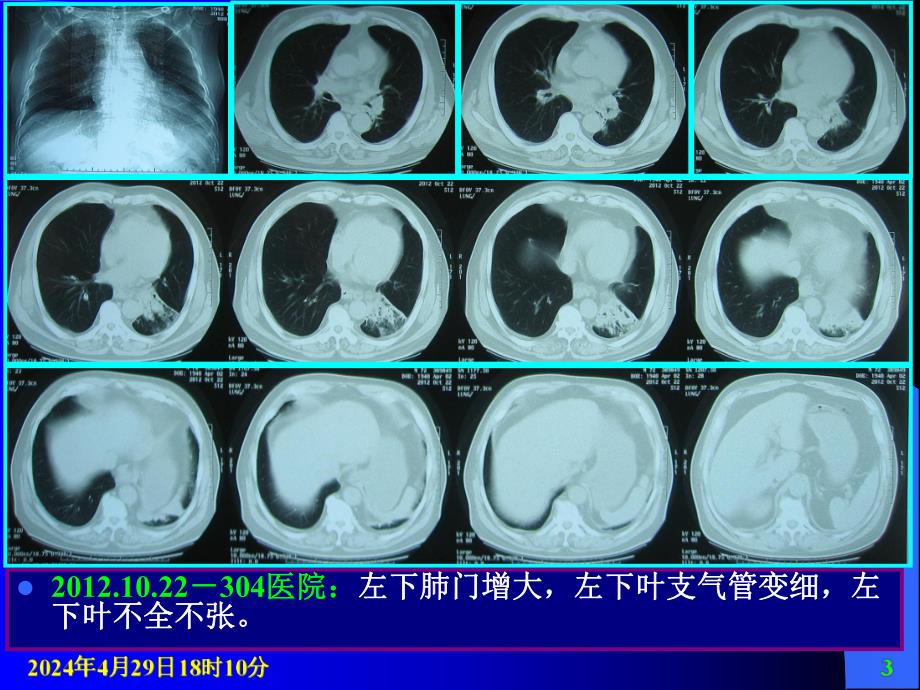 肺隔离症.ppt_第3页