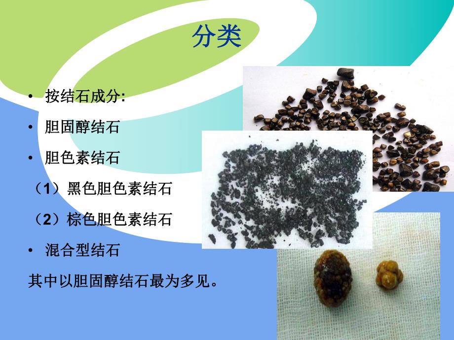 胆石症的护理查房.ppt_第3页