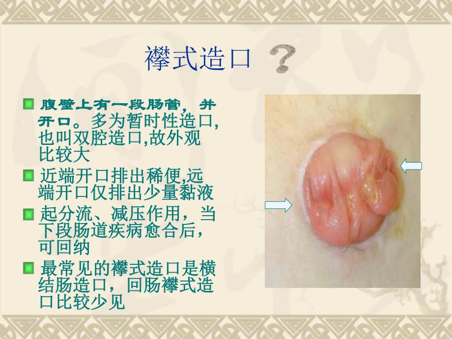 结肠造口病人的清洁灌肠方法医学幻灯片.ppt_第2页