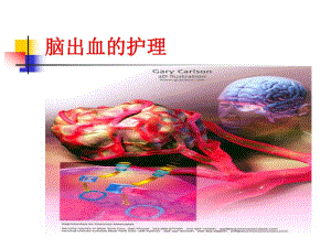 脑出血的护理.ppt.ppt