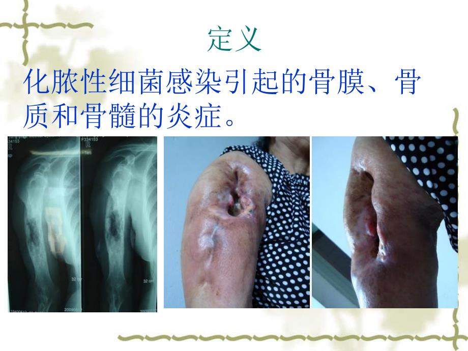 骨髓炎演示文稿.ppt_第2页