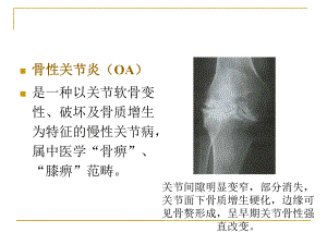 骨关节痹症(骨性关节炎).ppt.ppt