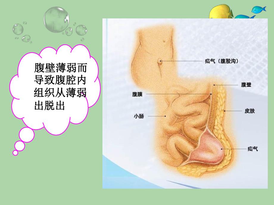 疝气手术配合.ppt_第3页