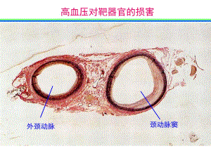 高血压对靶器官的损害.ppt