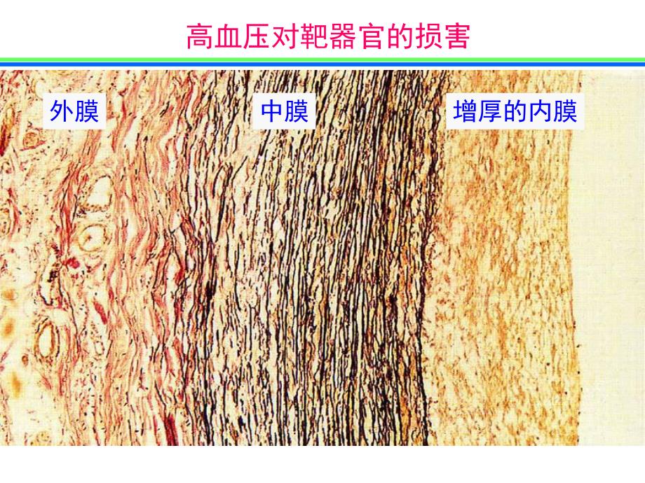高血压对靶器官的损害.ppt_第2页