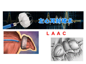 左心耳封堵术.ppt