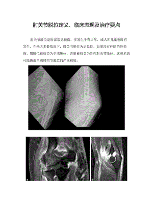 单纯肘关节脱位定义、临床表现及治疗要点.docx