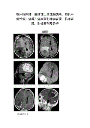 临床脑脓肿、静脉性出血性脑梗死、眼肌麻痹性偏头痛等头痛类型影像学表现、临床表现、影像鉴别及分析.docx