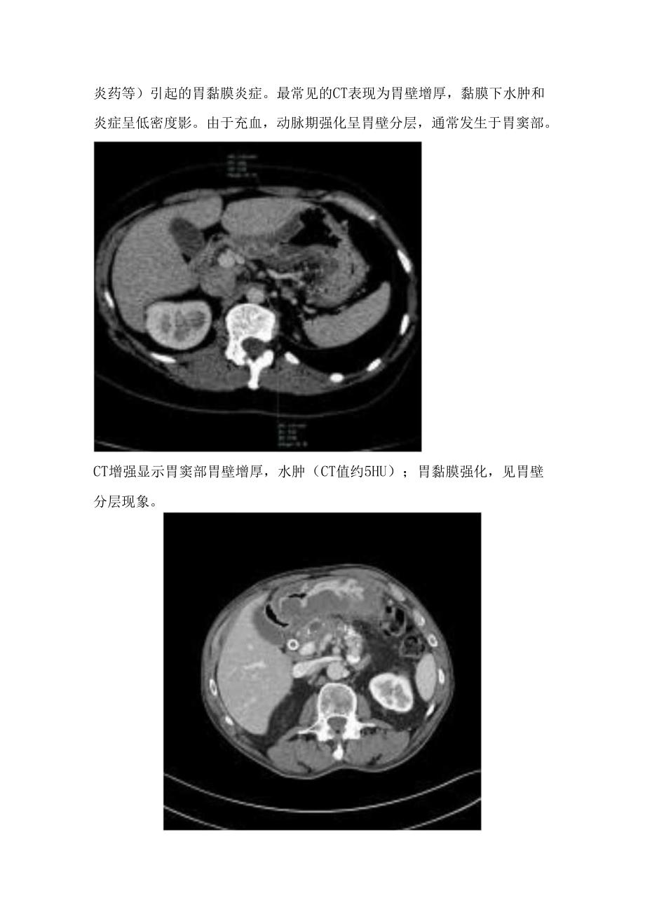 临床胃部CT扫描技术及炎性病变、梗阻性病变、穿孔性病变、血源性病变等急性胃痛CT表现.docx_第2页