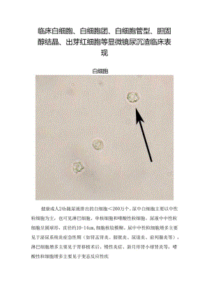 临床白细胞、白细胞团、白细胞管型、胆固醇结晶、出芽红细胞等显微镜尿沉渣临床表现.docx