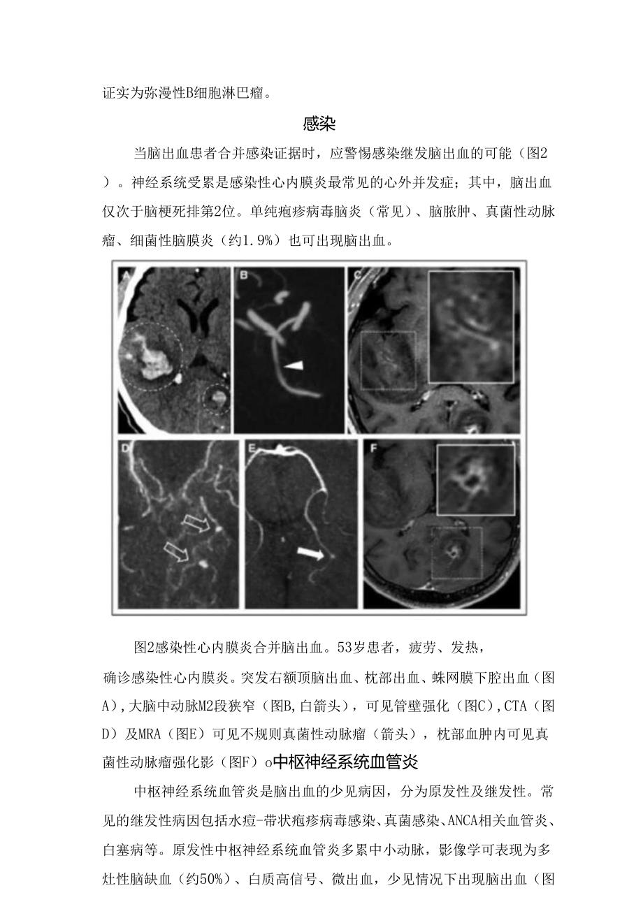 肿瘤、感染、中枢神经系统血管炎、脑血管畸形、术后远隔部位脑出血、甲醇中毒等颅内非创伤性出血少见病因及影像学特征.docx_第2页