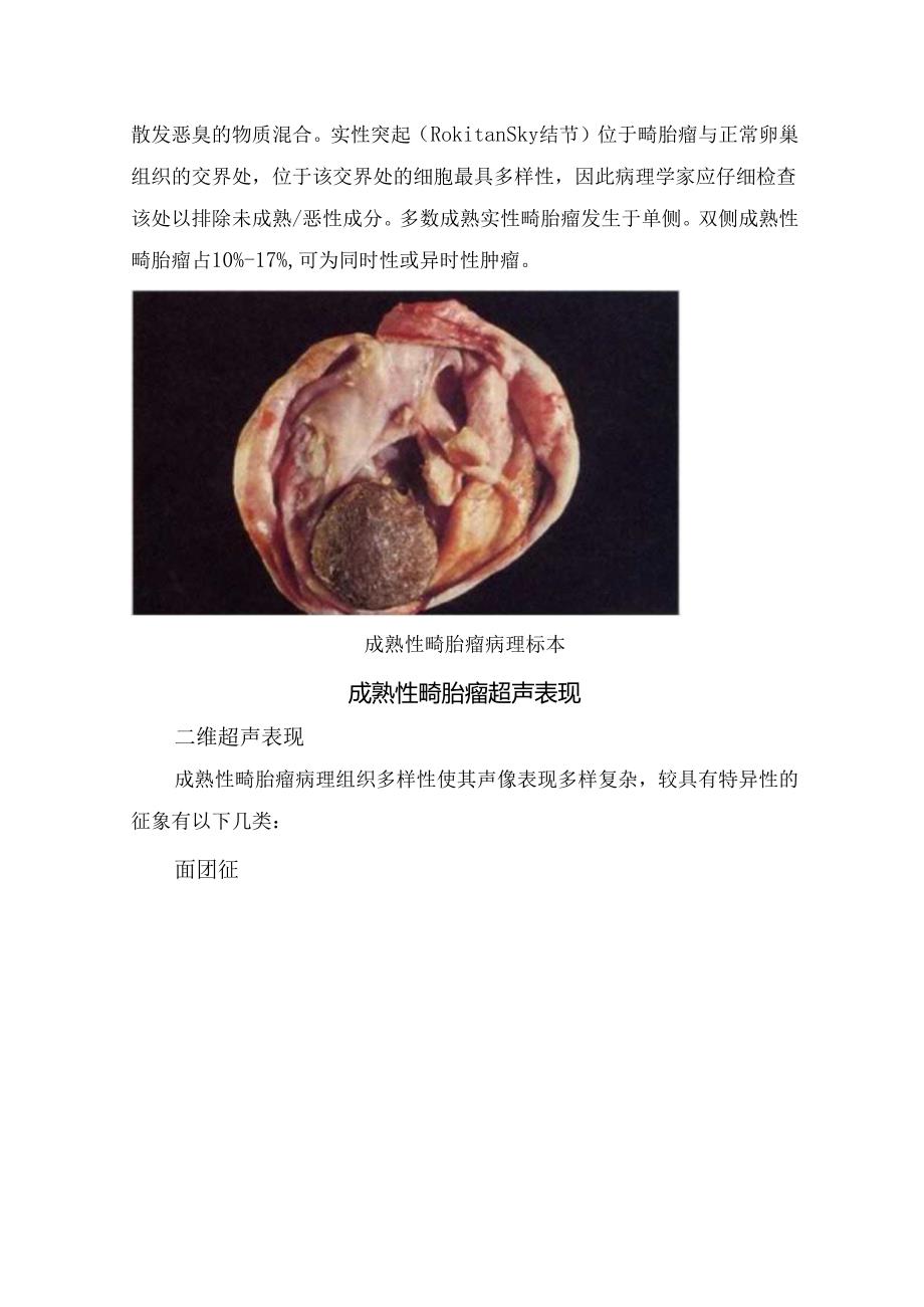 临床成熟性畸胎瘤类型、组织病理学及超声表现.docx_第3页