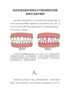 临床龋齿临床表现及水平颤动拂刷法和圆弧刷牙法操作要领.docx