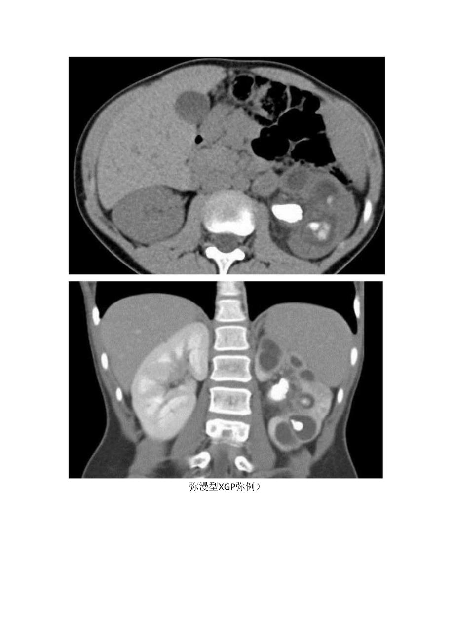 黃色肉芽肿性肾盂肾炎流行病学、临床表现、病理及影像学表现.docx_第3页