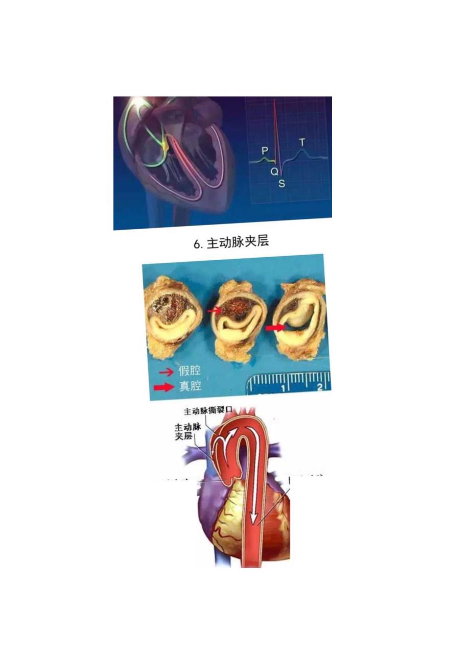 心脏传导系统、冠心病、心电图、抗心律失常药、高血压联合用药等心血管疾病原理.docx_第3页