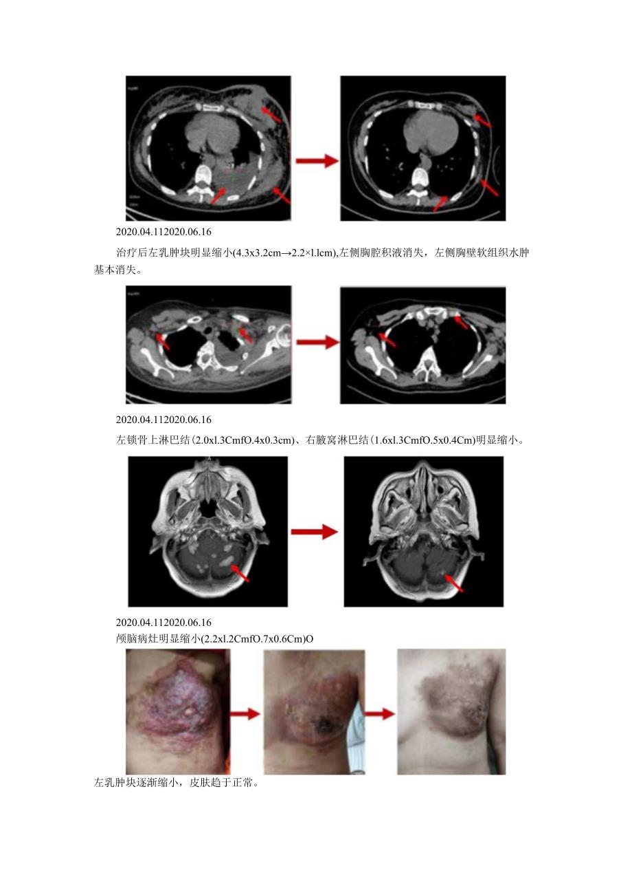 HER2 阳性晚期乳腺癌伴脑转移患者双靶治疗的思考.docx_第2页