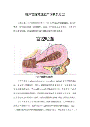 临床宫腔粘连超声诊断及分型.docx