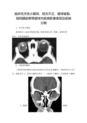 临床先天性小眼球、屈光不正、眼球破裂、视网膜脱离等眼球内疾病影像表现及疾病分期.docx