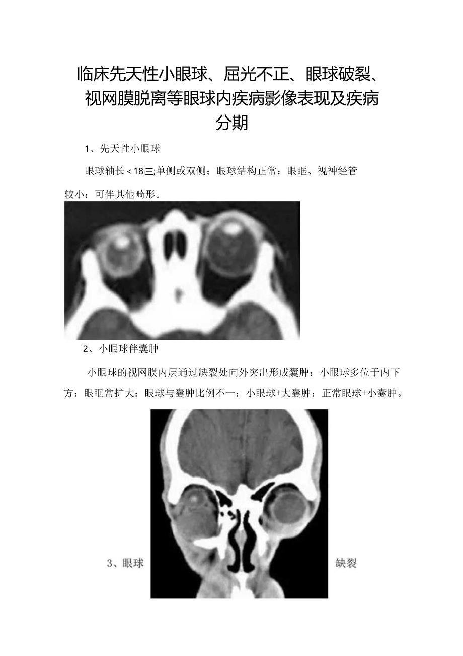 临床先天性小眼球、屈光不正、眼球破裂、视网膜脱离等眼球内疾病影像表现及疾病分期.docx_第1页