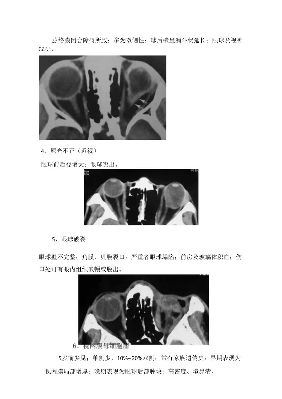 临床先天性小眼球、屈光不正、眼球破裂、视网膜脱离等眼球内疾病影像表现及疾病分期.docx_第2页
