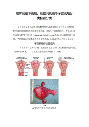 临床黏膜下肌瘤、肌壁间肌瘤等子宫肌瘤分类位置分类.docx