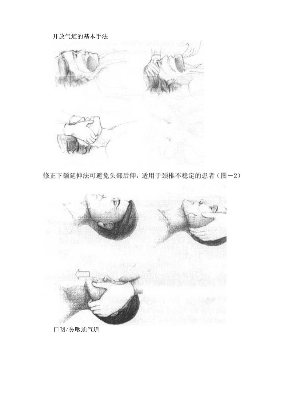 临床急救气管插管及紧急气道管理要点.docx_第3页
