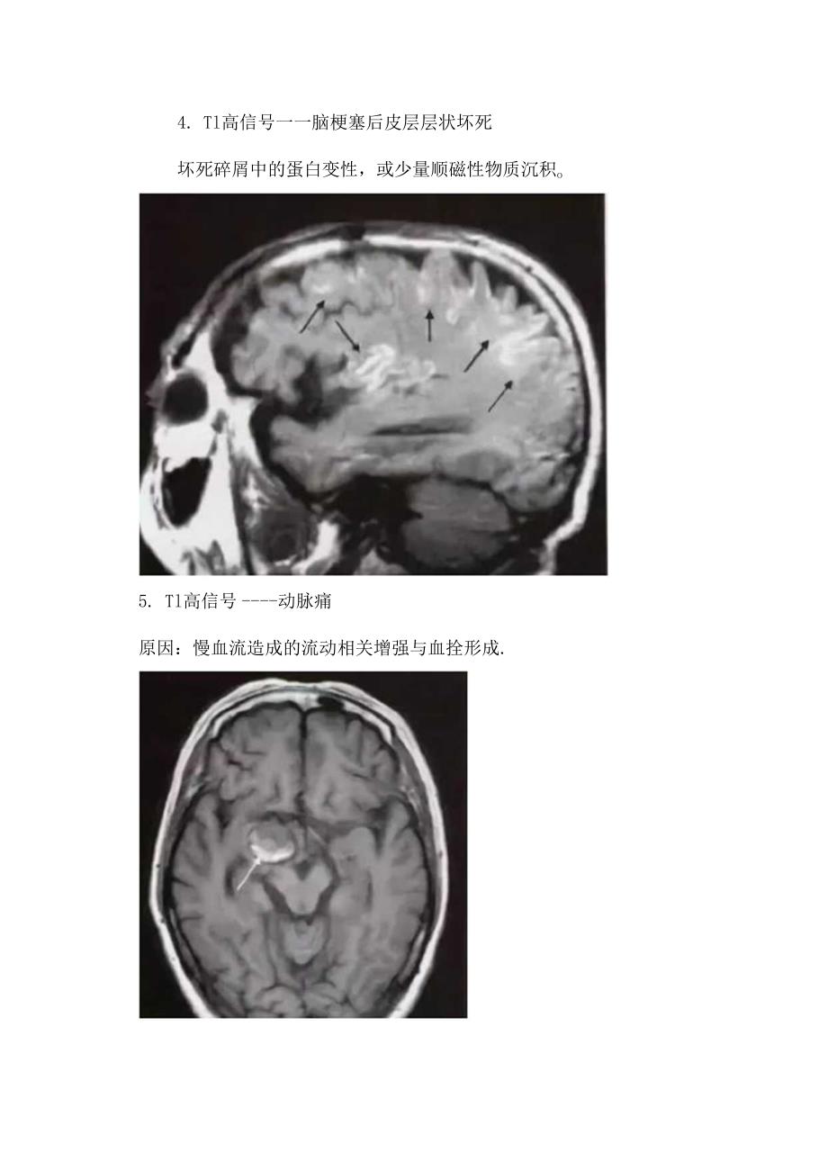 临床T1高信号指示意义及胼胝体脂肪瘤、出血、脑梗塞出血转化等疾病影像学表现.docx_第3页