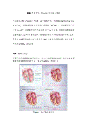 2024阵发性室上性心动过速诊断与管理.docx