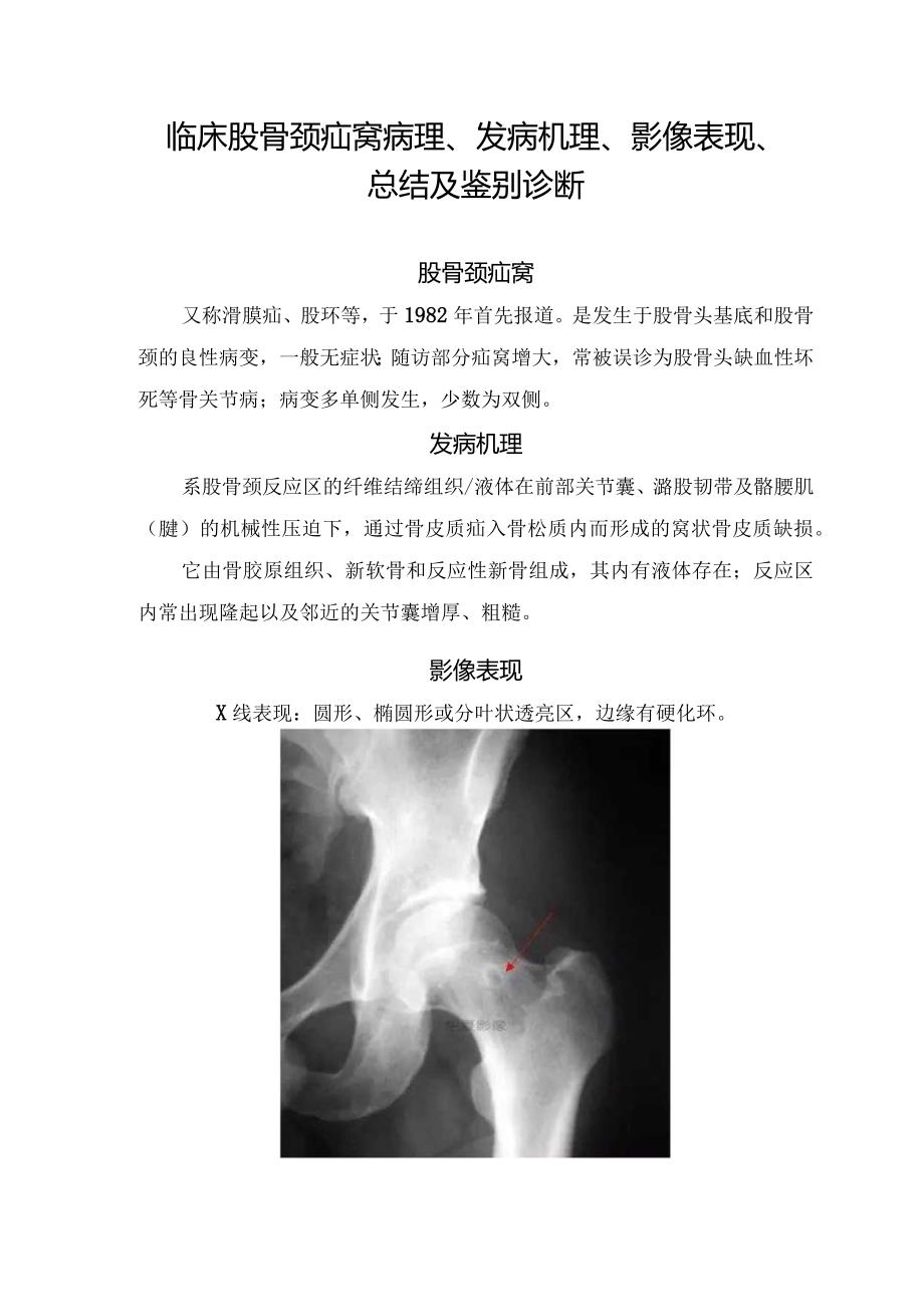 临床股骨颈疝窝病理、发病机理、影像表现、总结及鉴别诊断.docx_第1页